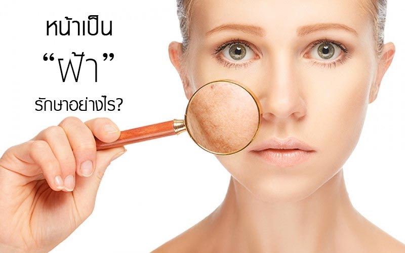 หน้าเป็นฝ้ารักษาอย่างไร